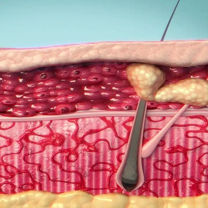 How Agnes RF - Dynamic precision rf microneedling non-surgical device works