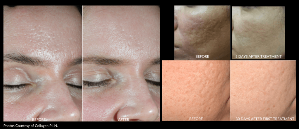 Collagen P.I.N. Individual Results - Aesthetic Management Partners