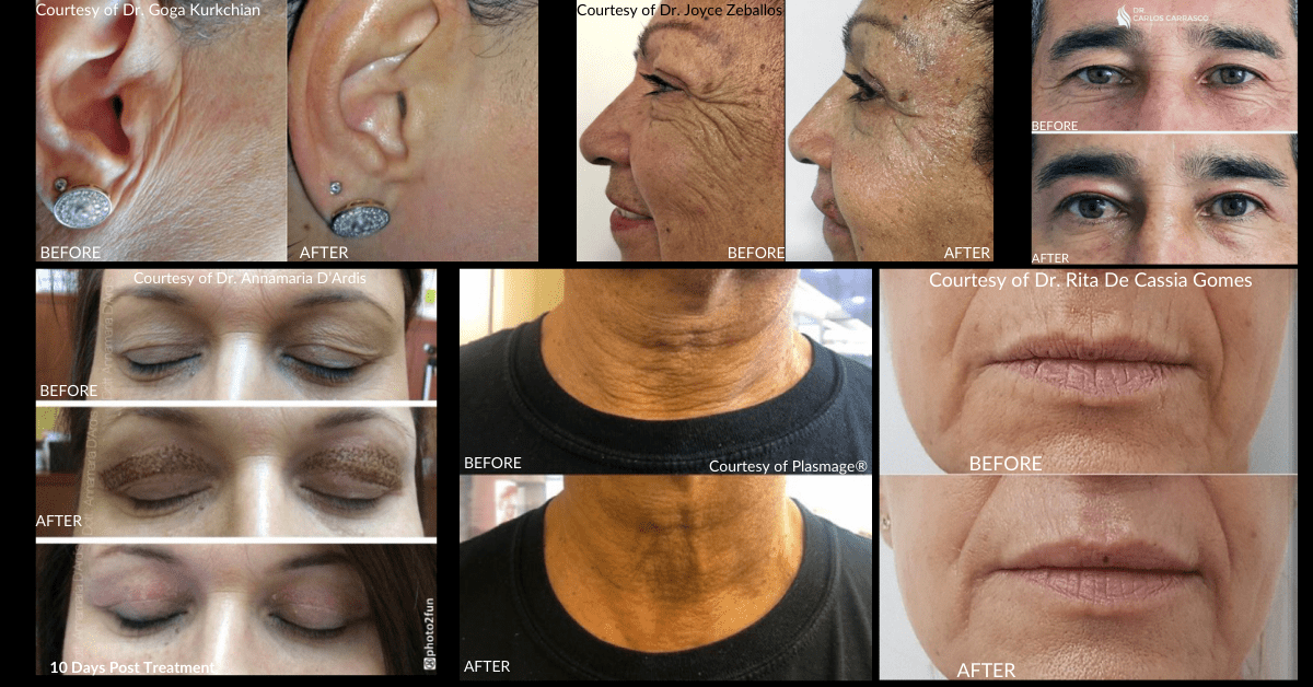 Plasmage® Before and After Photos - Plasmage® is a Fractional Plasma Technology is a non-surgical option for crepey skin, hooded eyes, wrinkles and other skin concerns - Aesthetic Management Partners