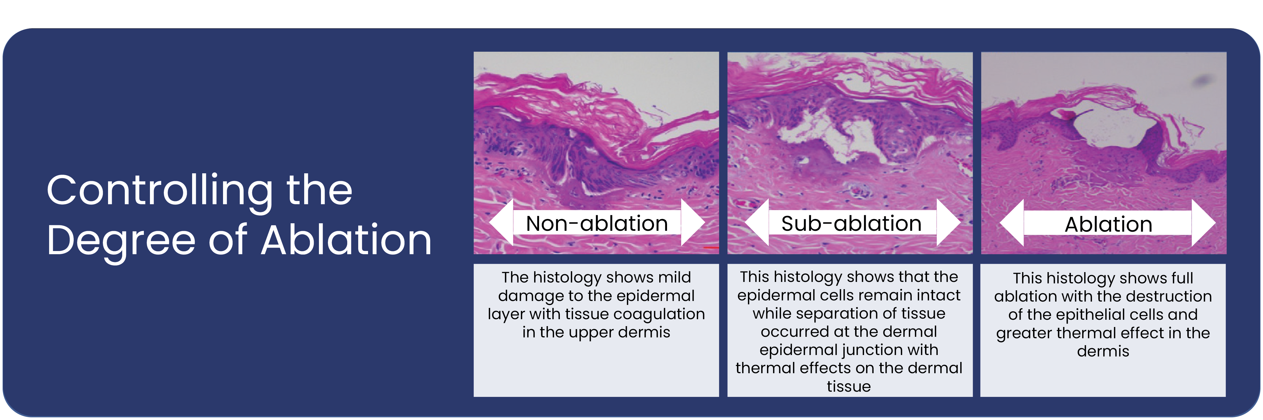 NOUVADerm™ Degree of ablation