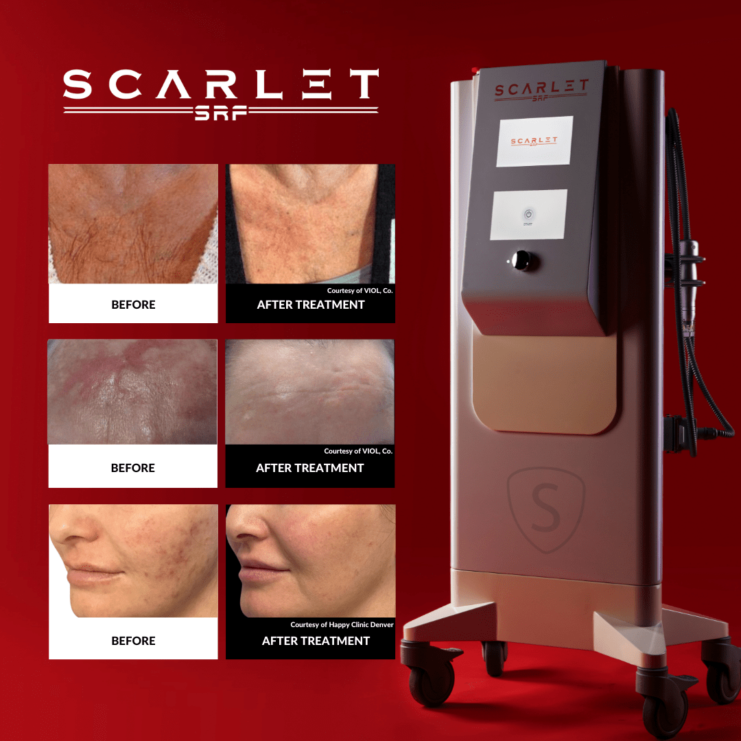 Scarlet SRF before and after photos showing the outcomes possible with rf microneedling with scarlet srf.