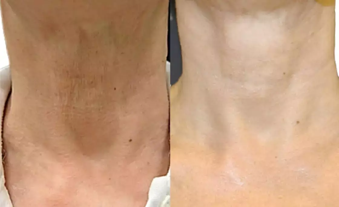 Neck2 - Aesthetic Management Partners - Medical Aesthetics Equipment For The Modern Practice