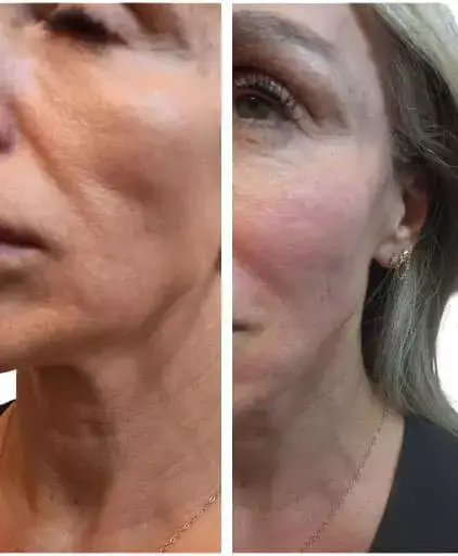 cellenis derma face 2 1 - Aesthetic Management Partners - Medical Aesthetics Equipment For The Modern Practice