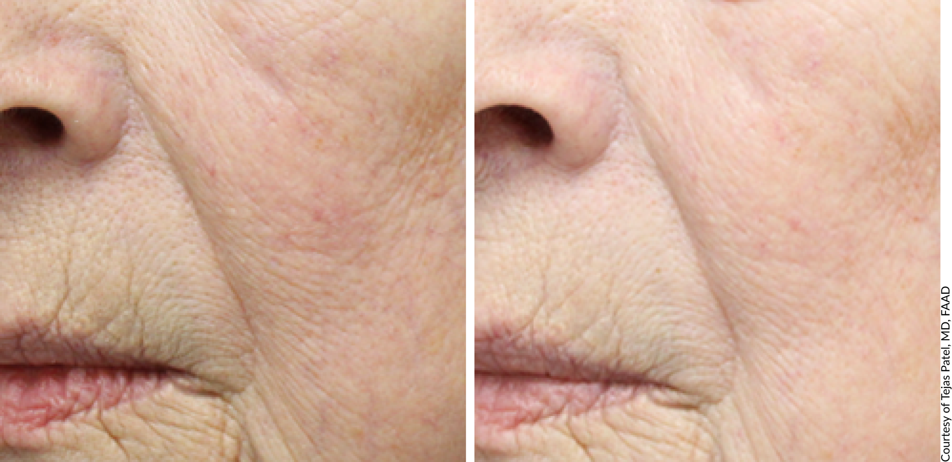 derive age defying serum before and after 2 - Aesthetic Management Partners - Medical Aesthetics Equipment For The Modern Practice