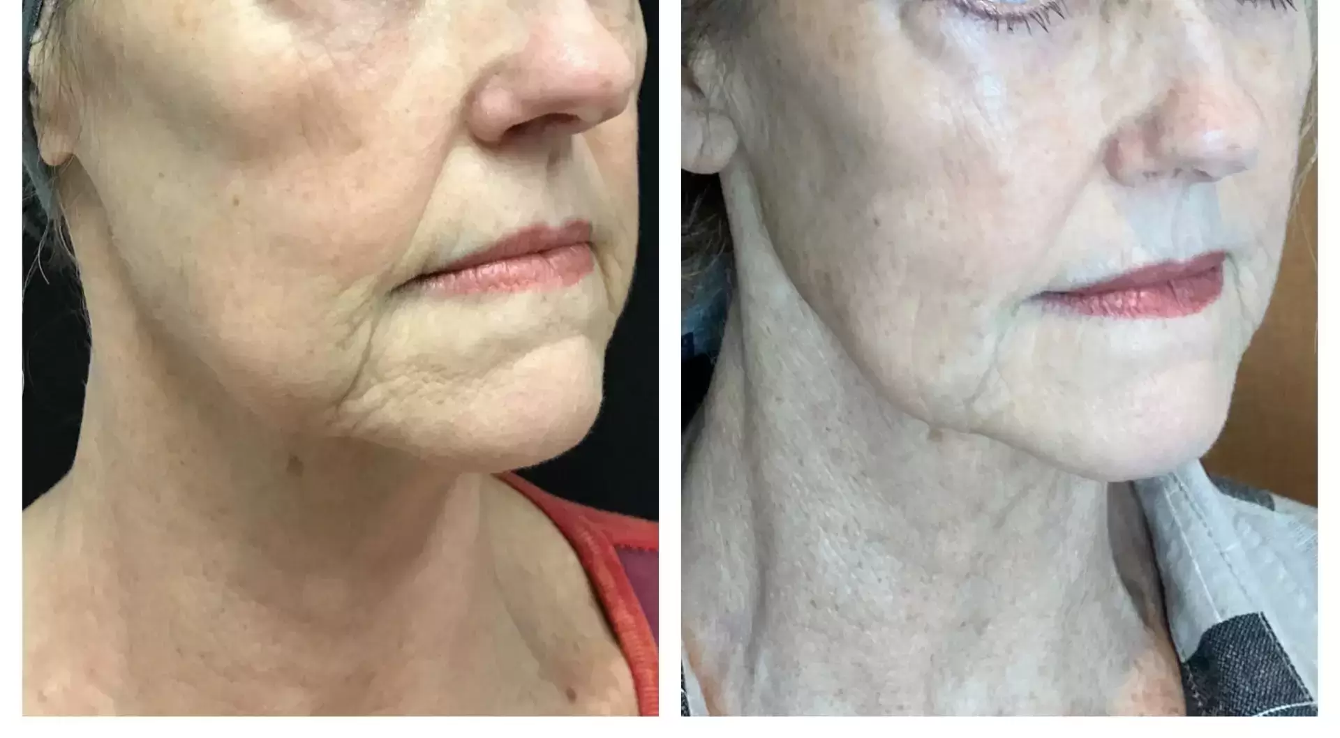 Scarlet Neck Cheeks Jawline L.Aesthetics Longevity R.View - Aesthetic Management Partners - Medical Aesthetics Equipment For The Modern Practice