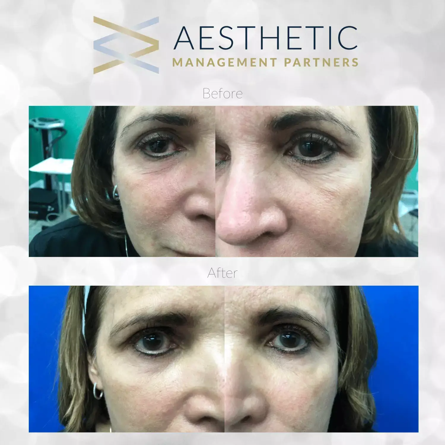 Agnes Eyes KovakCosmeticCenter - Aesthetic Management Partners - Medical Aesthetics Equipment For The Modern Practice