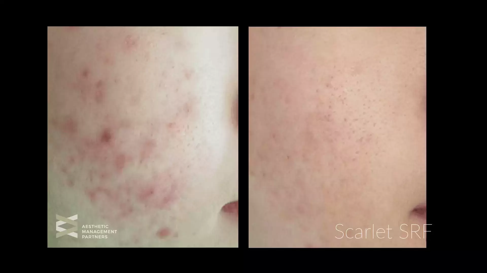 Scarlet Acne - Aesthetic Management Partners - Medical Aesthetics Equipment For The Modern Practice