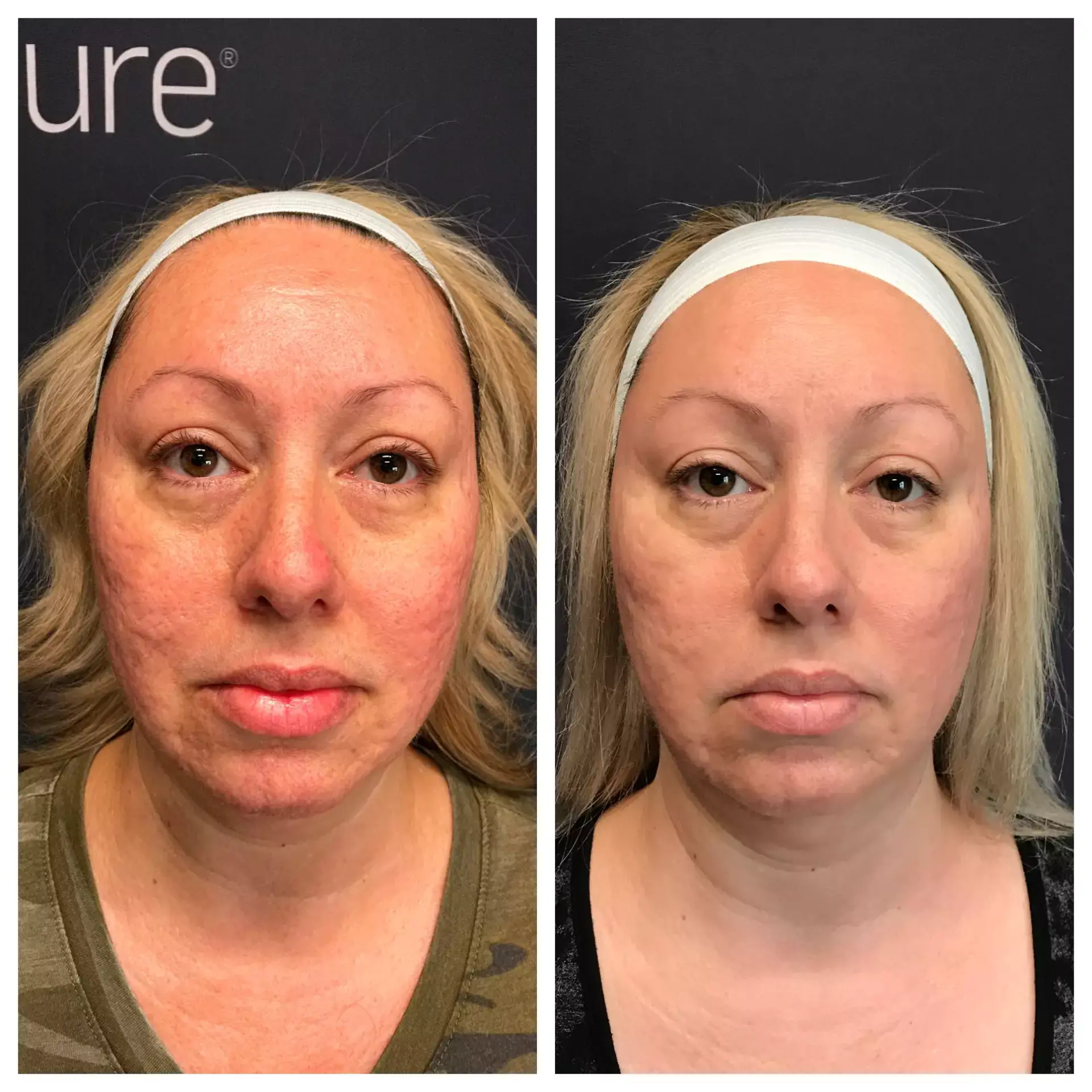 Scarlet AcneScars3 GoodyearFamilyMedicine - Aesthetic Management Partners - Medical Aesthetics Equipment For The Modern Practice