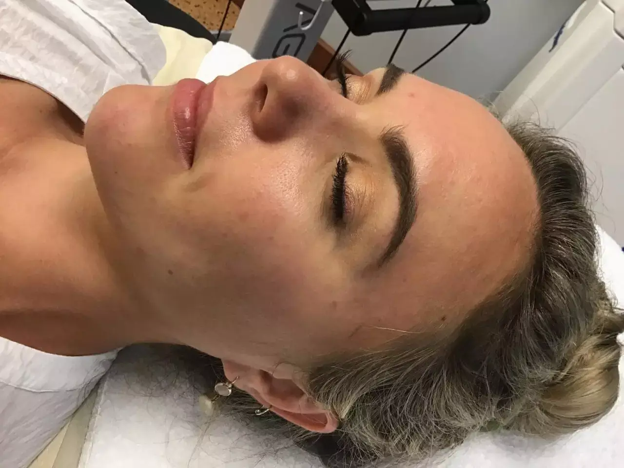Agnes AcneAfter CatalystMedCenter 1 - Aesthetic Management Partners - Medical Aesthetics Equipment For The Modern Practice