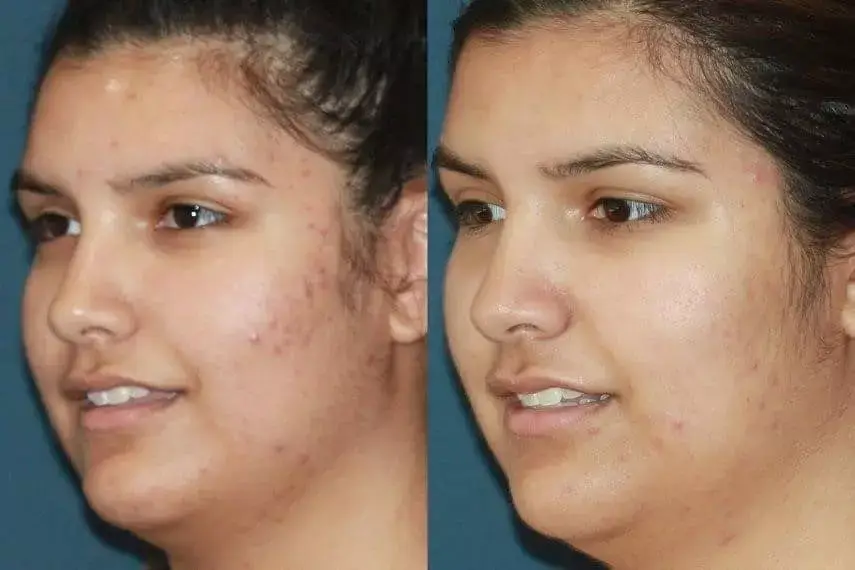 Agne Chin Skin LaserCenter Left Oblique - Aesthetic Management Partners - Medical Aesthetics Equipment For The Modern Practice