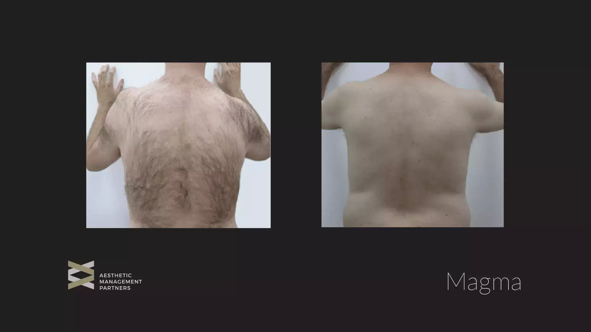 Magma Back HairRemoval - Aesthetic Management Partners - Medical Aesthetics Equipment For The Modern Practice