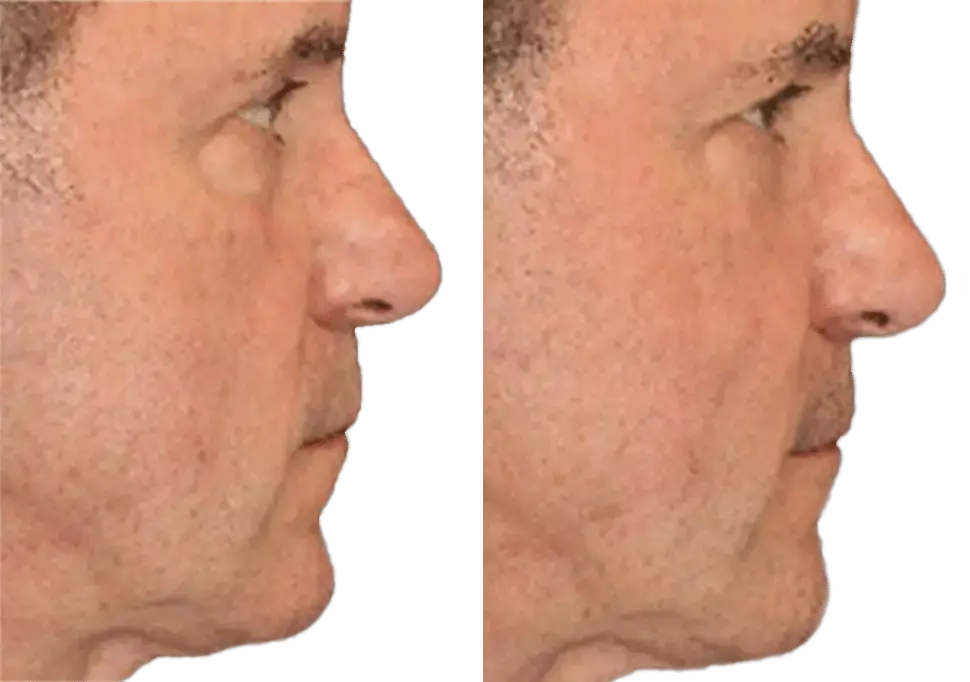 Male Face 1 - Aesthetic Management Partners - Medical Aesthetics Equipment For The Modern Practice