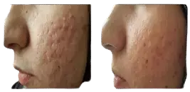 cellenis derma cheek - Aesthetic Management Partners - Medical Aesthetics Equipment For The Modern Practice