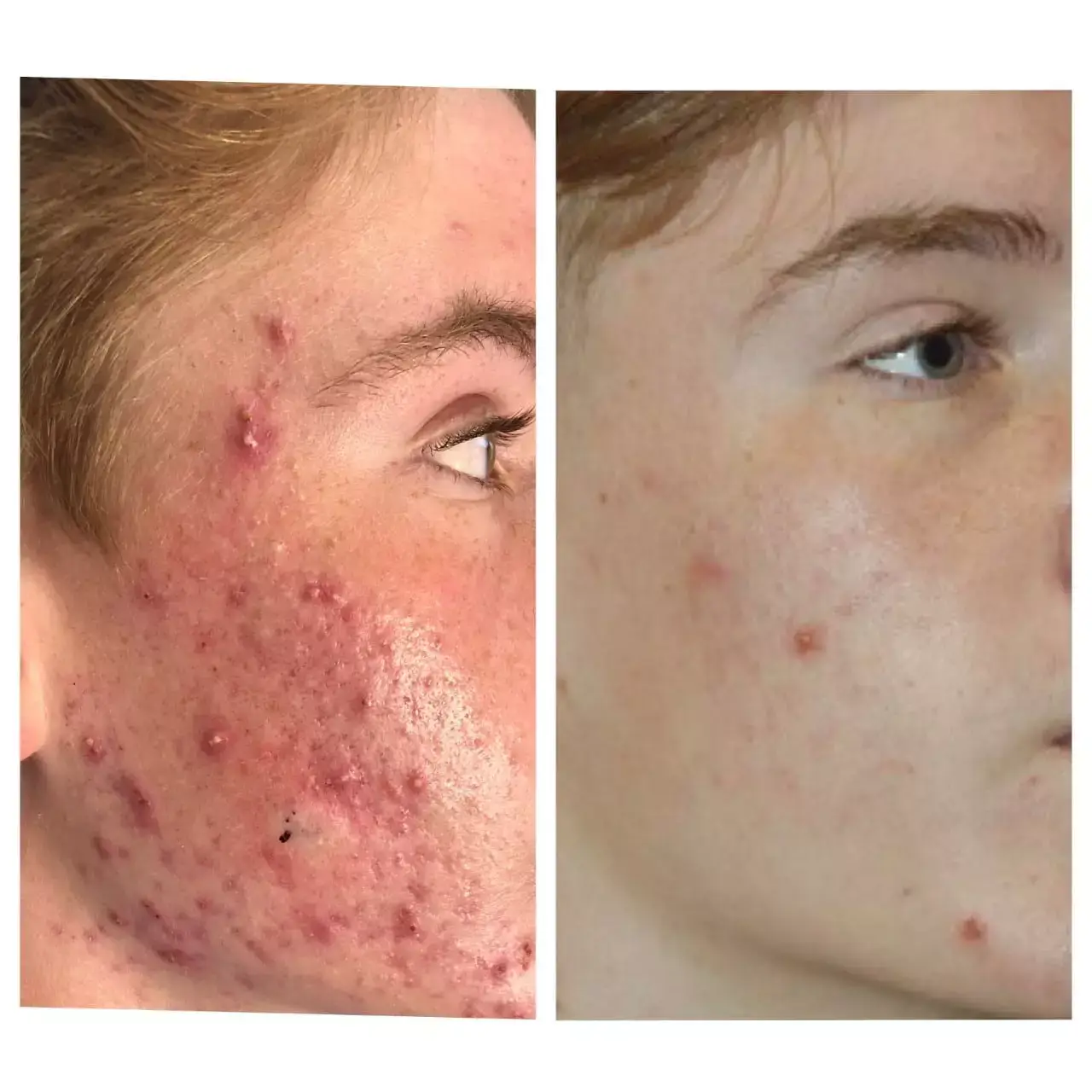 Agnes Acne BealsMD - Aesthetic Management Partners - Medical Aesthetics Equipment For The Modern Practice