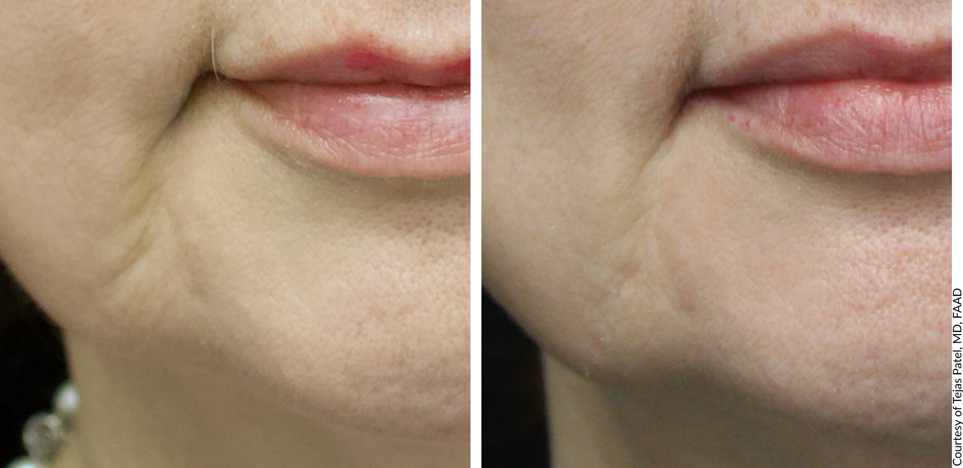 derive age defying serum before and after 1 - Aesthetic Management Partners - Medical Aesthetics Equipment For The Modern Practice