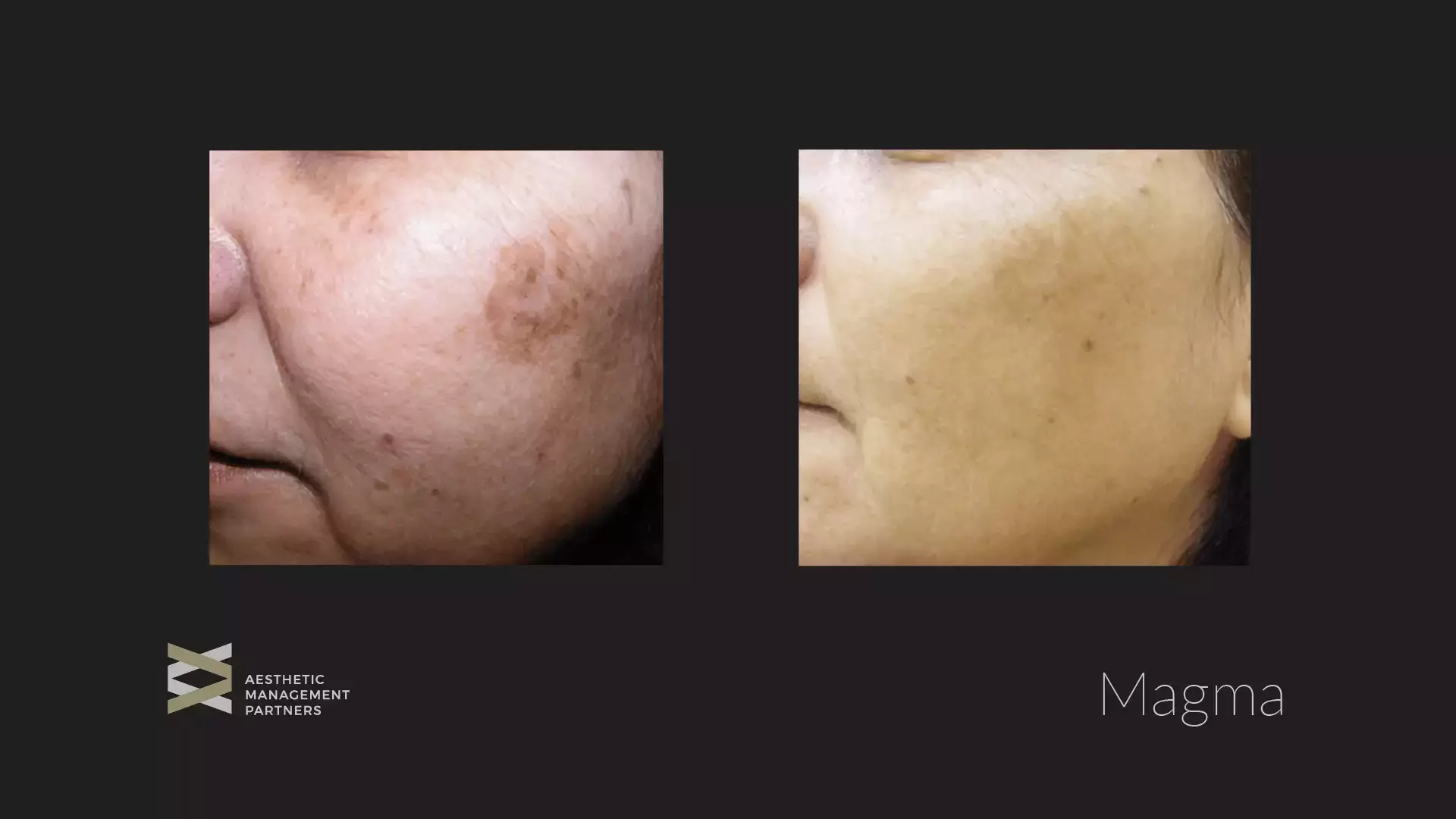 Magma Face Pigmentation - Aesthetic Management Partners - Medical Aesthetics Equipment For The Modern Practice