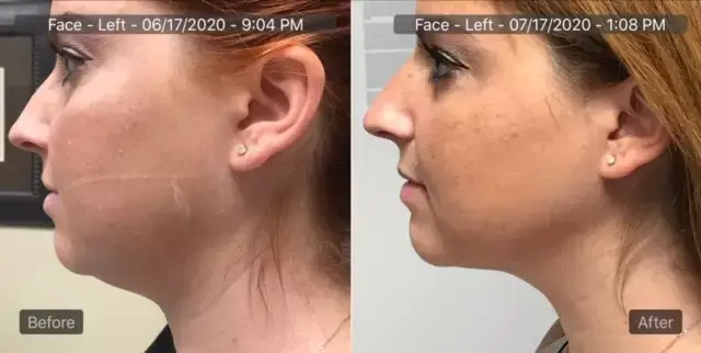 Agnes Chin and Jowls LookGreatMD - Aesthetic Management Partners - Medical Aesthetics Equipment For The Modern Practice
