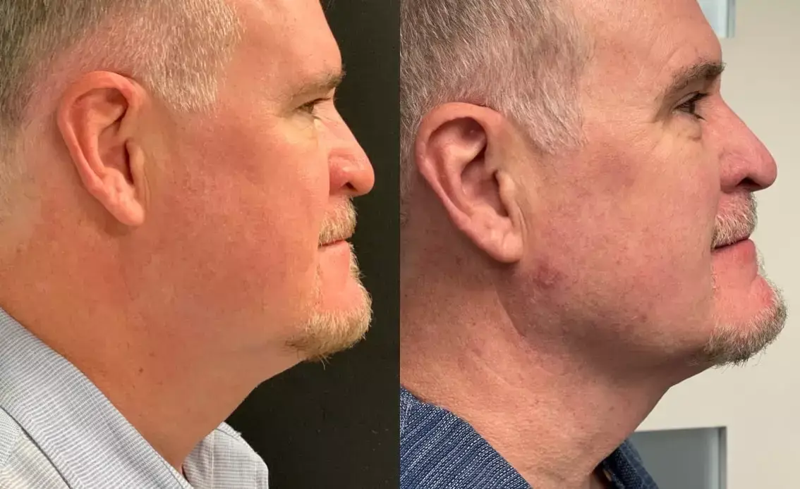 agnes neck courtesy of Alfonso Fuentes - Aesthetic Management Partners - Medical Aesthetics Equipment For The Modern Practice