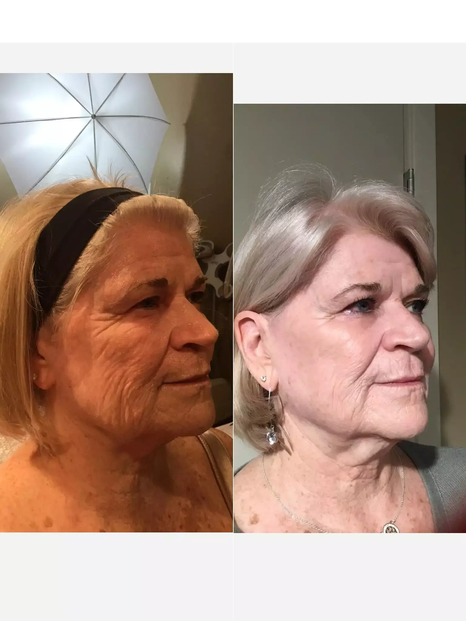 Scarlet Face and Neck McRaeMDMedicalLaserCenter R.View - Aesthetic Management Partners - Medical Aesthetics Equipment For The Modern Practice